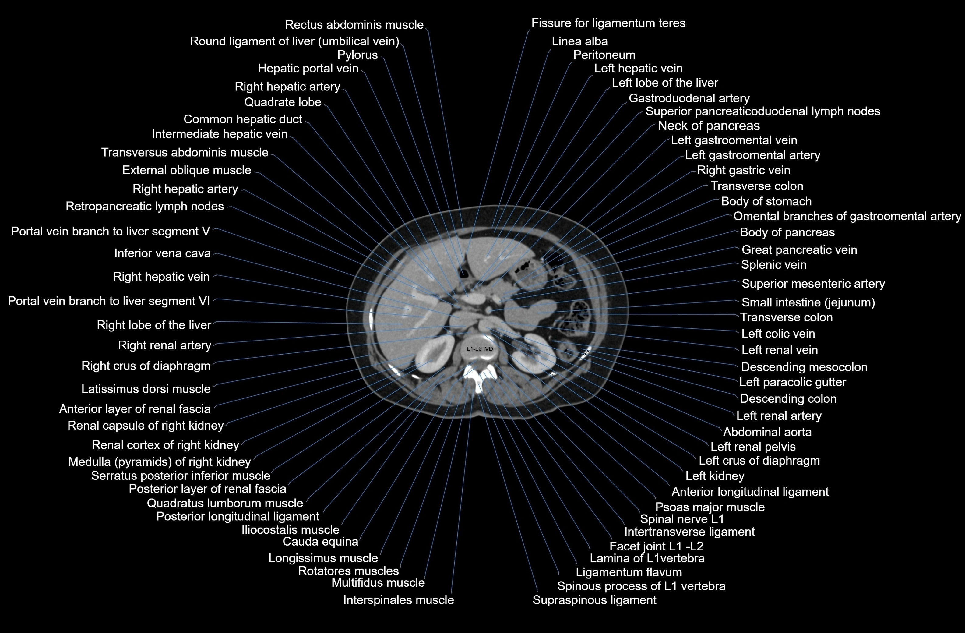 CT Abdomen axial cross sectional anatomy labelled radiology image-00030.webp